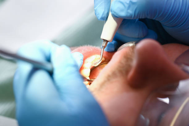 Best Emergency Tooth Extraction in Nolanville, TX